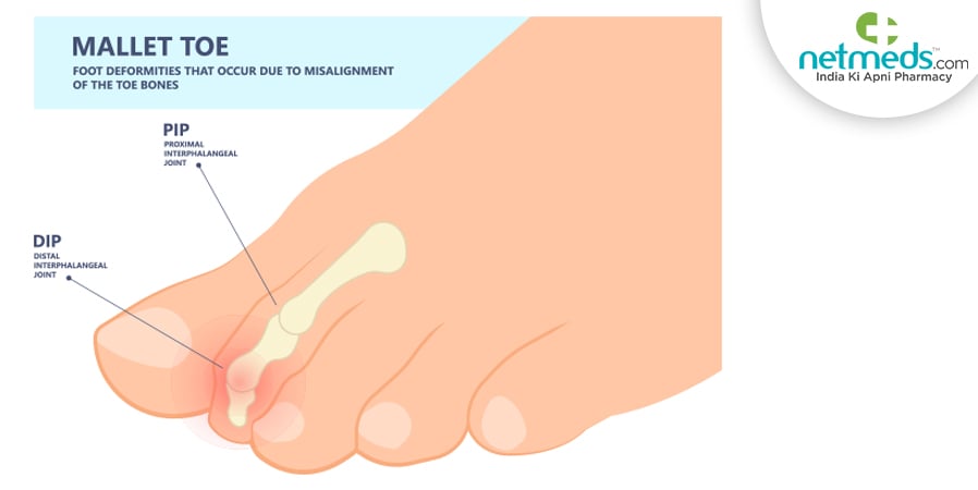 Mallet Toes