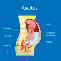 Ayurveda For Ascites: Leverage The Benefits Of These Astounding Herbs To Treat Abdominal Distension