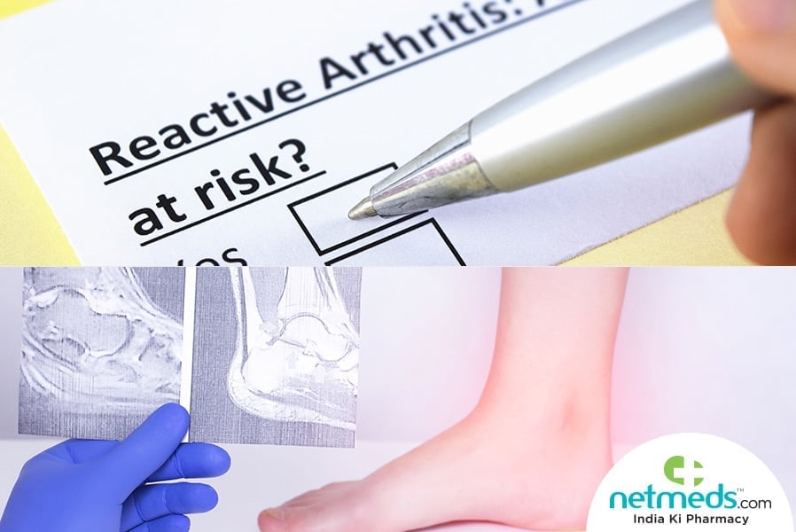 reactive arthritis
