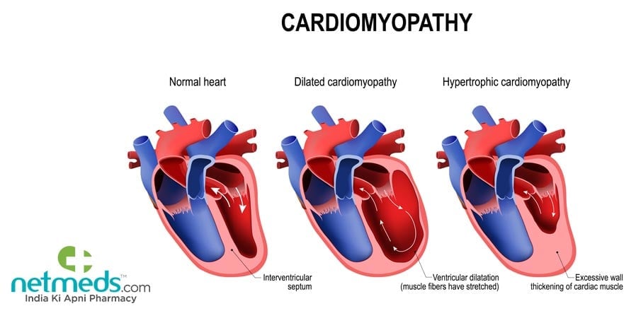 Cardiomyopathy - Normal heart, dilated cardiomyopathy, hypertrophic cardiomyopathy