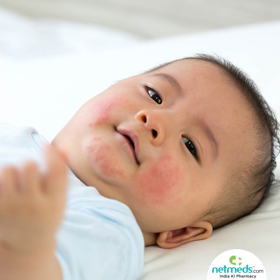 Natural remedies to promote baby's skin