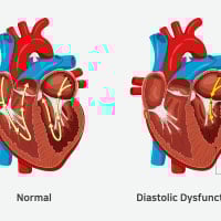 Heart Failure: Symptoms, Causes, Types And Treatment