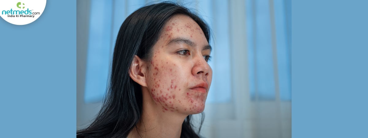cystic acne