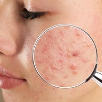 Hormonal Acne: Causes, Symptoms, and Treatment