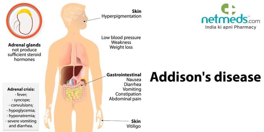 Addison's disease
