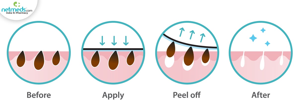 blackhead removal