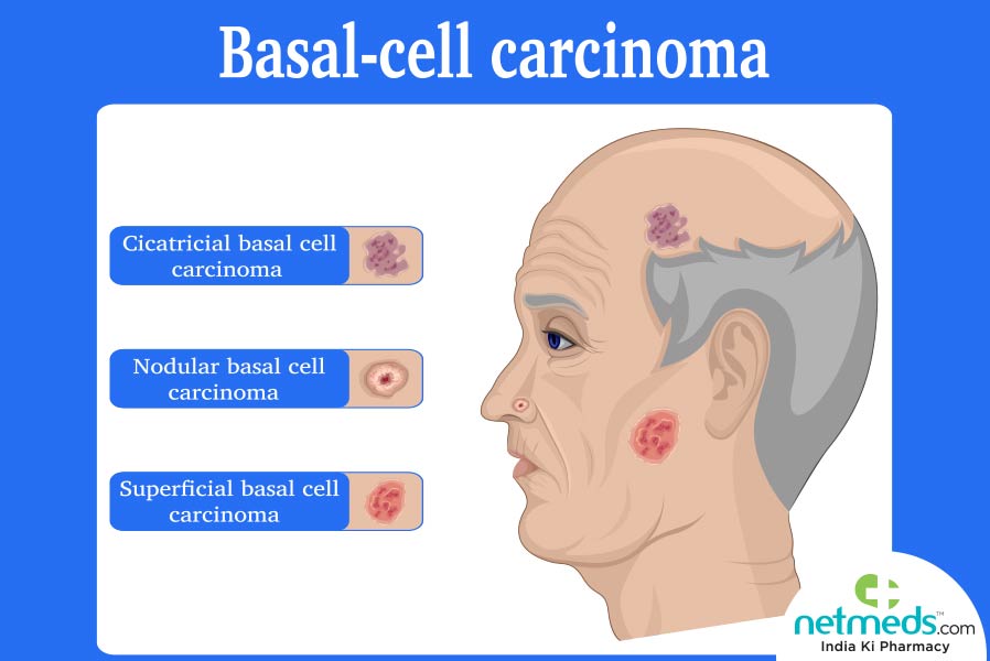 Basal cell carcinoma