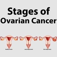 Ovarian Cancer: Causes, Symptoms, And Treatment