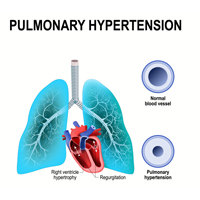 Pulmonary Hypertension: Causes, Symptoms And Treatment