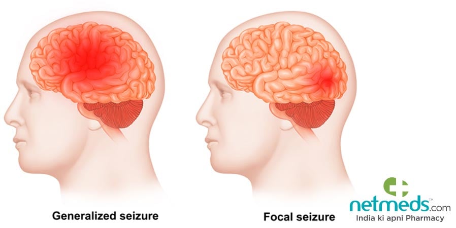 Focal seizure