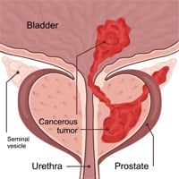 Seminal Vesicle Cancer: Causes, Symptoms And Treatment