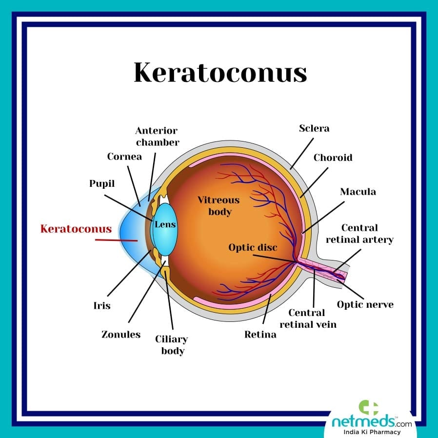 Keratoconus