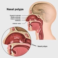 Nasal Polyps: Causes, Symptoms And Treatment