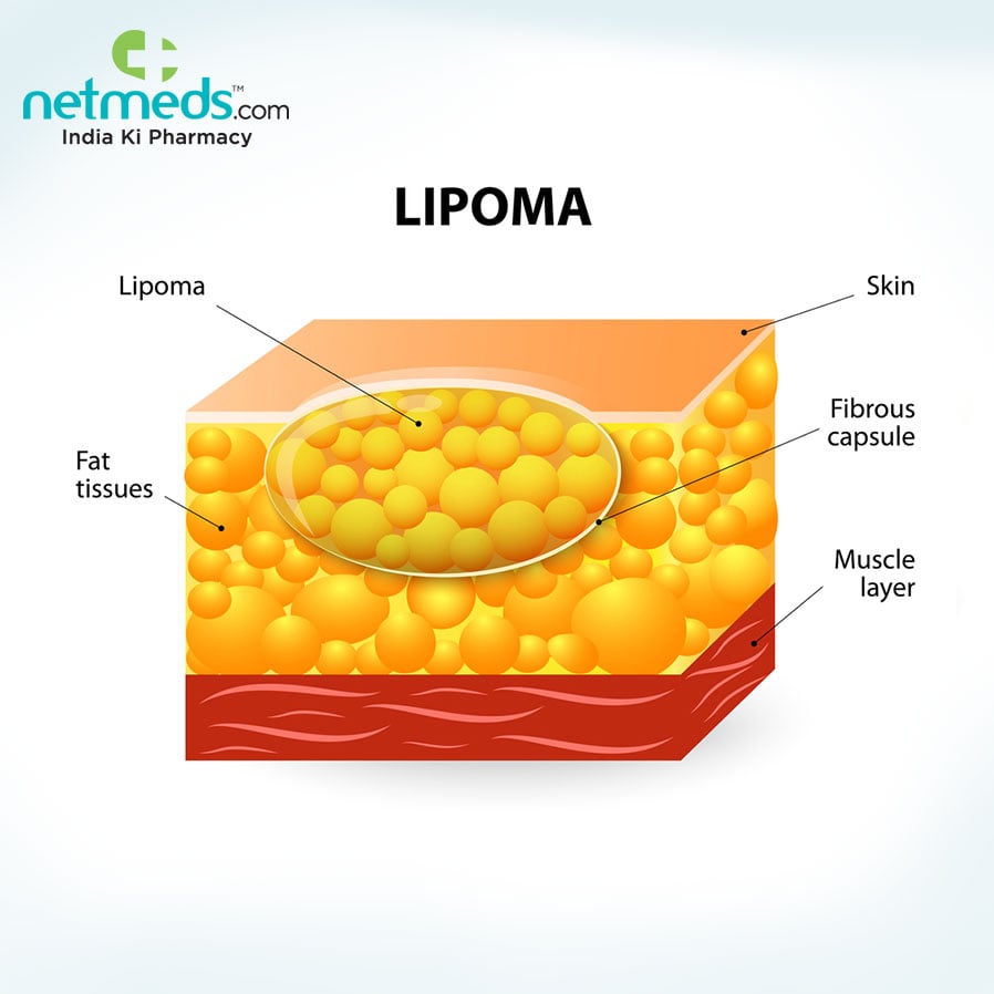 Lump could be a lipoma