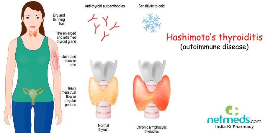 Hashimoto's Thyroiditis