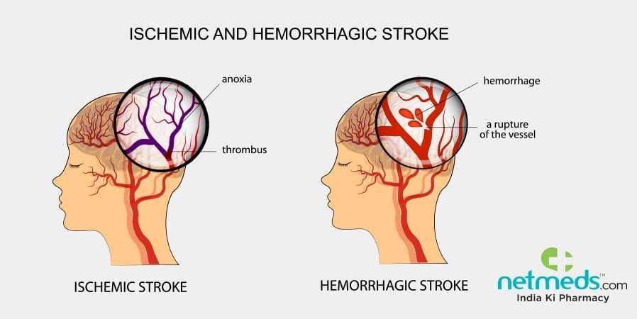 stroke causes