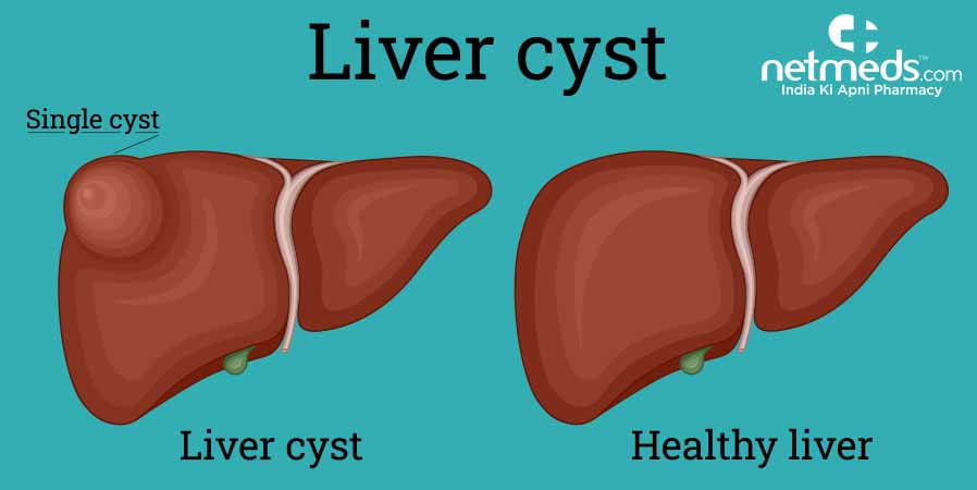 Liver cyst