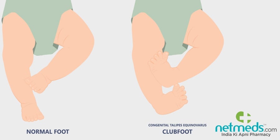 Normal foot and clubbed foot