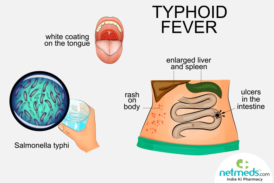 typhoid fever