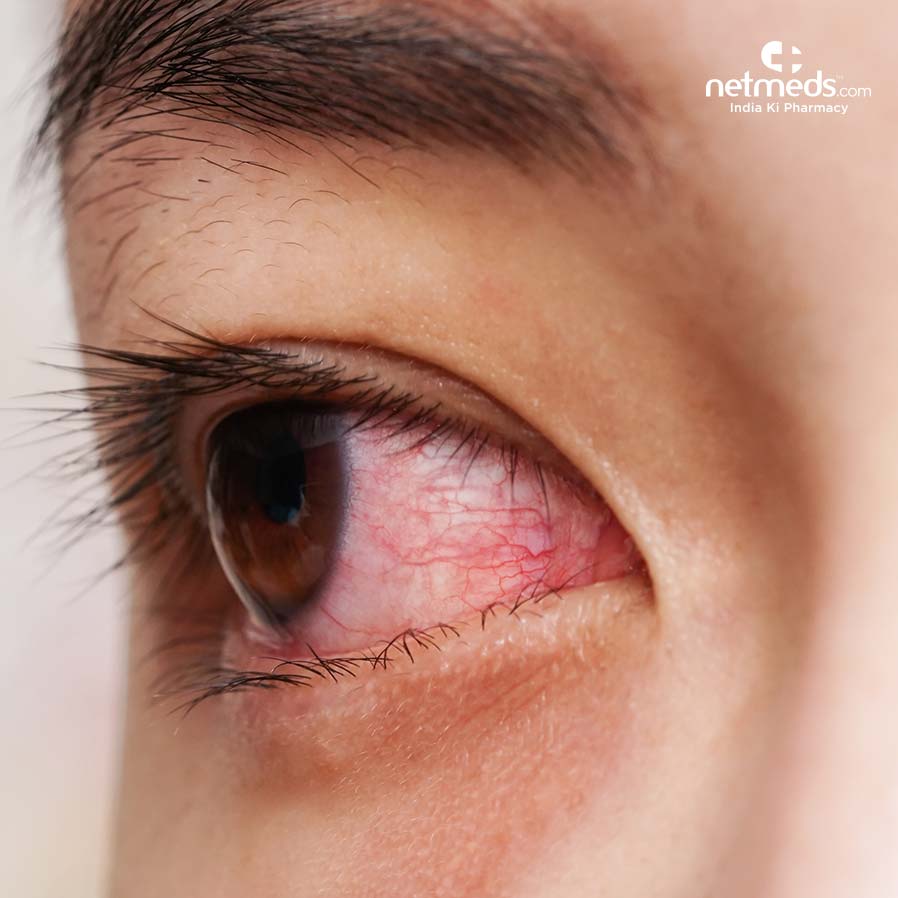 Conjunctivitis