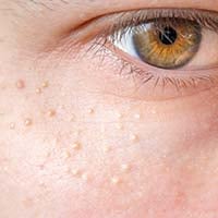 Chicken Skin Under Eyes: Causes, Symptoms And Treatment