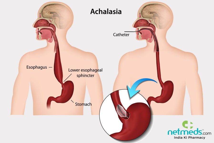 achalasia