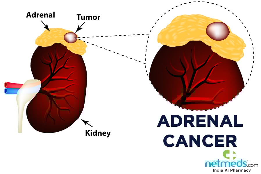 adrenal cancer