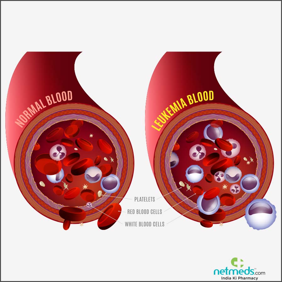 leukemia causes