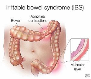 IBS
