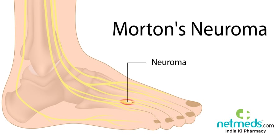 neuroma