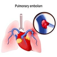 Pulmonary Embolism: Know The Causes, Symptoms And Treatment Of Blood Clot In The Lungs