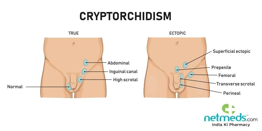 Causes, Symptoms And Treatment Of Cryptorchidism