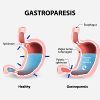 Gastroparesis: Causes, Symptoms And Treatment