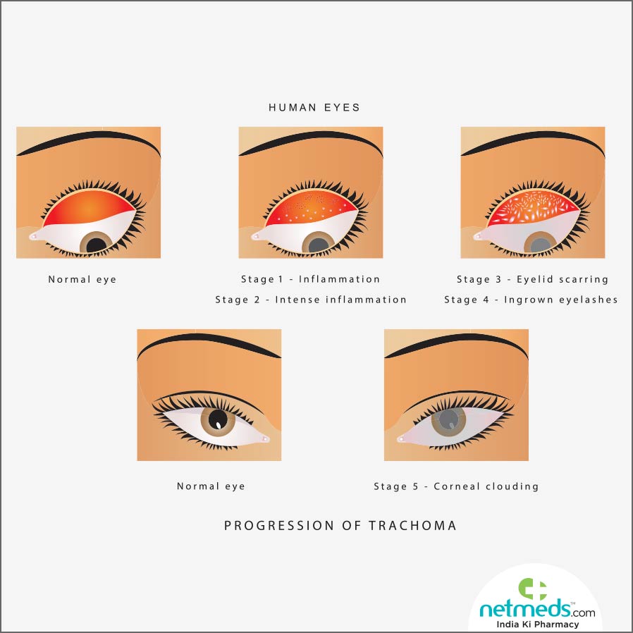 Trachoma stages