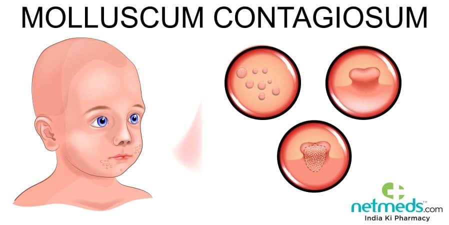 Molluscum contagiosum