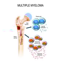 Multiple Myeloma: Causes, Symptoms And Treatment