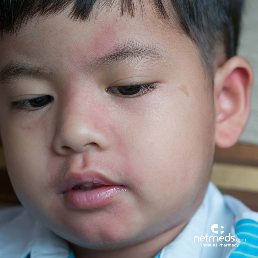 Boy with mumps