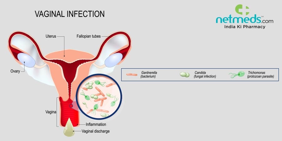 Vaginal Infection