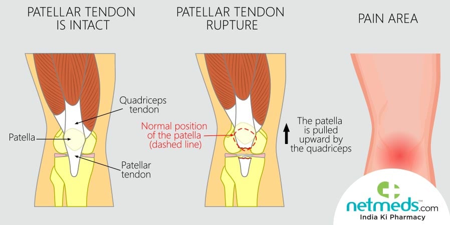 Jumper's knee Treatment