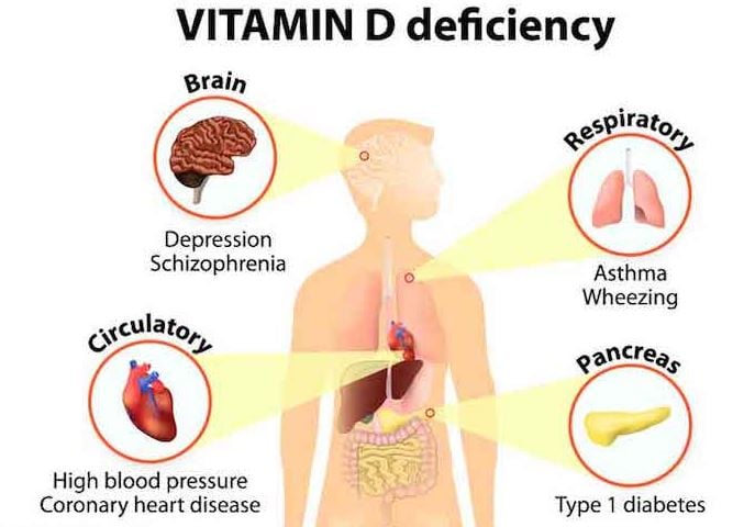 Vitamin D deficiency