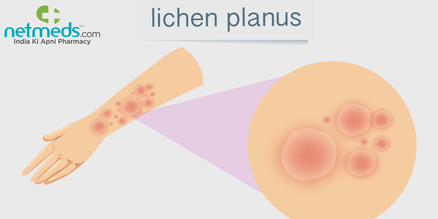 Lichen planus