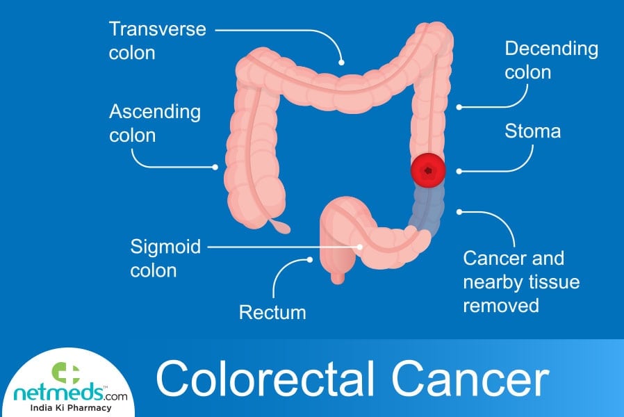 rectal cancer causes