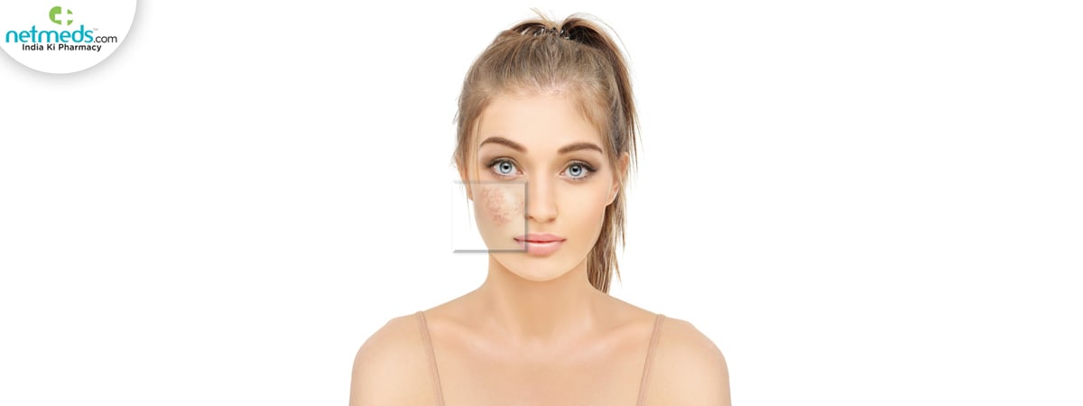 Broken capillaries