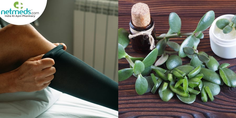 Varicose veins remedies