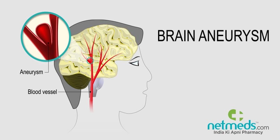 Brain aneurysm