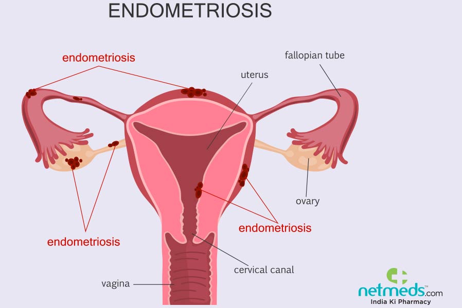 Endometriosis