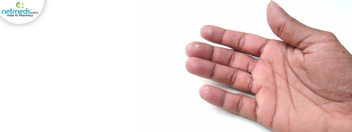 fingertips peeling