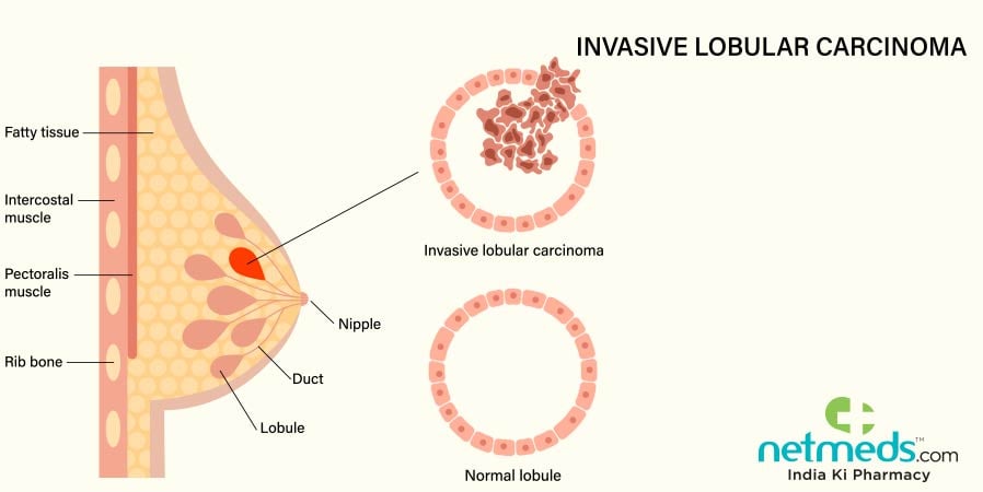 Invasive Lobular Carcinoma