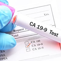CA19-9 Tumour Biomarker Test: What Is It? Purpose, Procedure, and Results
