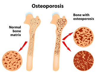 osteoporosis